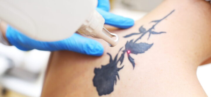 Rimozione tatuaggi